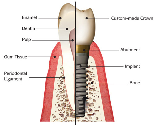 Implant Compared to Natural Tooth