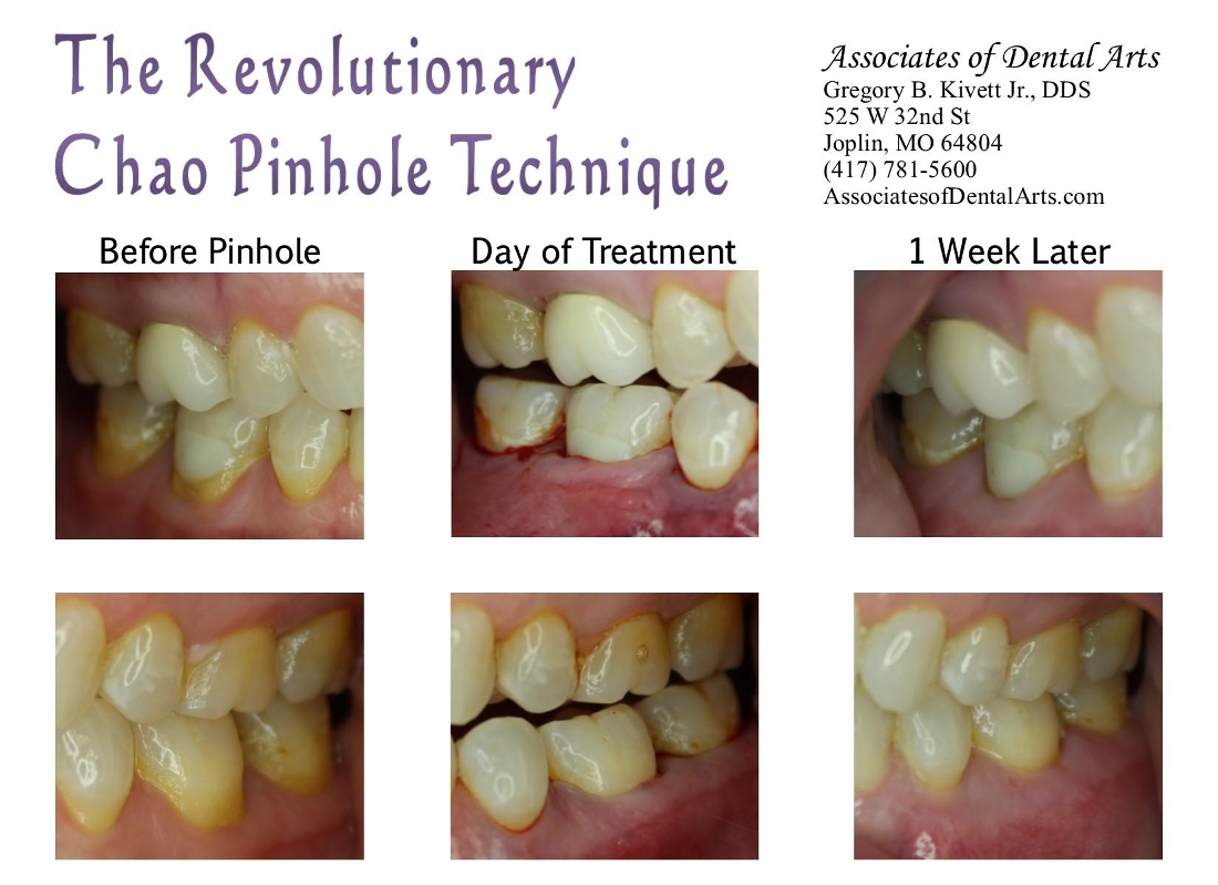 Receding Gums? Associates of Dental Arts Has the Answer Pinhole