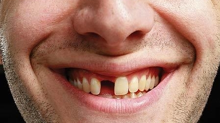 Missing a Tooth, No Problem! A Quick Look At Your Options | Treatment