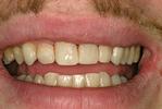 Composite-Repair-of-Decayed-Teeth-After-Image