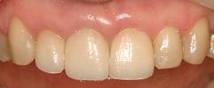 Porcelain-Crowns-After-Image