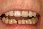 Dental-Bonding-Before-Image