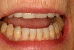 Dental-Bonding-After-Image