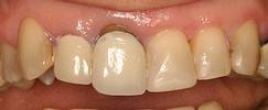 Porcelain-Crowns-Before-Image