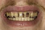 Composite-Repair-of-Decayed-Teeth-Before-Image